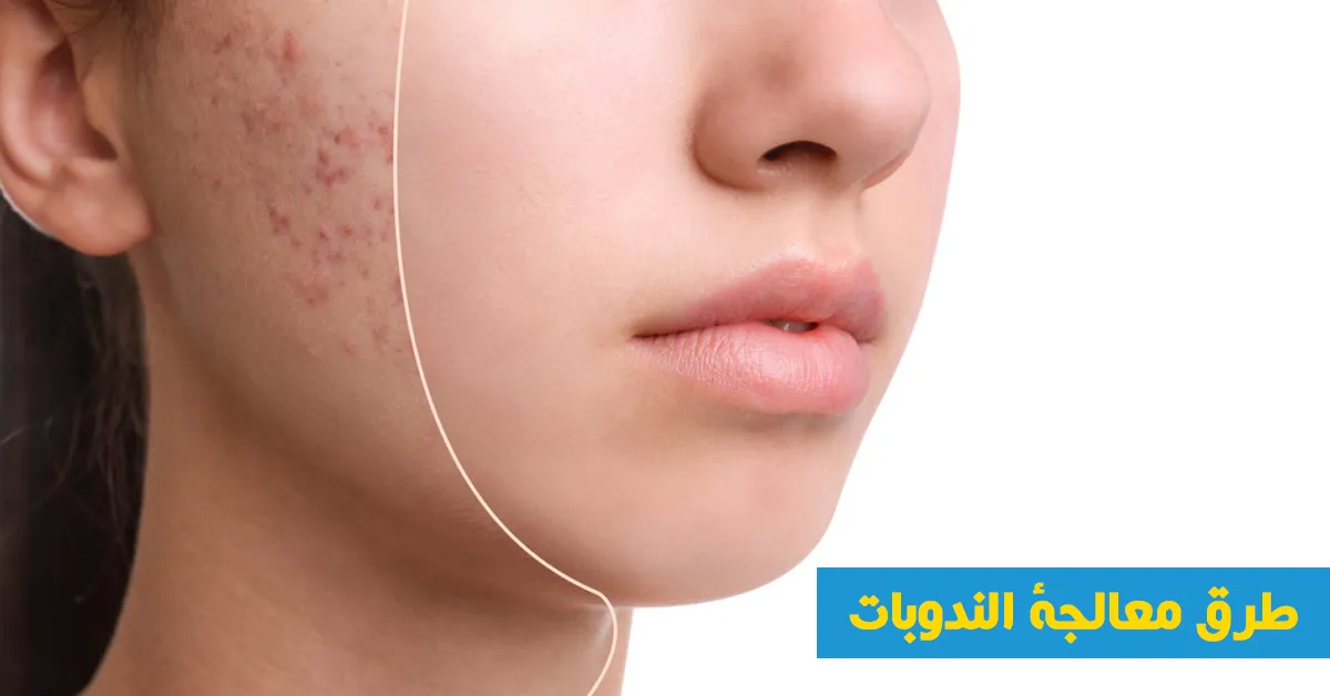 طرق معالجة الندوبات